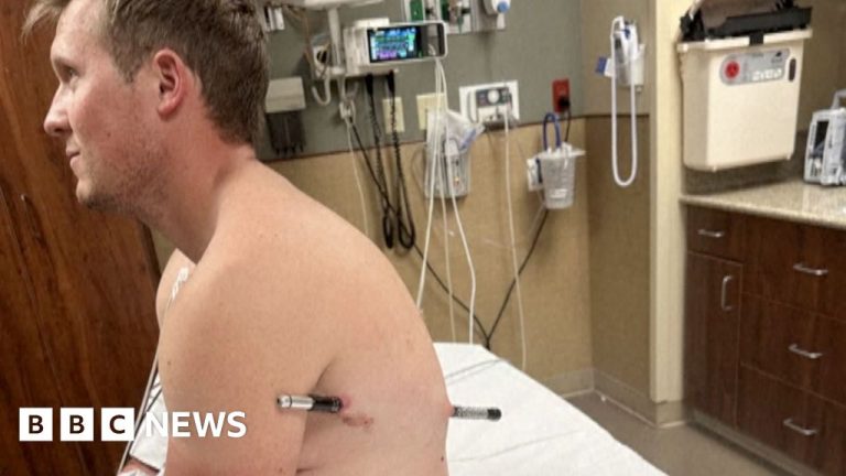 Man impaled by a hiking pole treks 10 miles down mountain