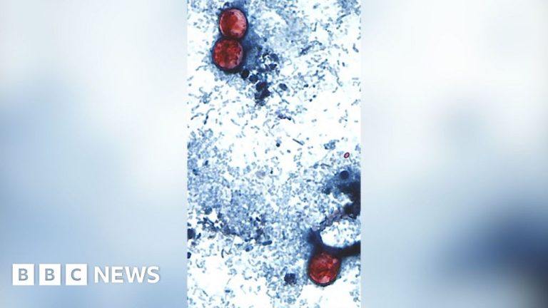 US reports first two deaths linked to parasitic infection outbreak