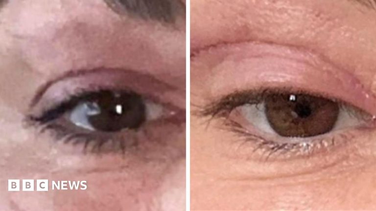 ‘My eyelids became infected – I was scared to sleep’