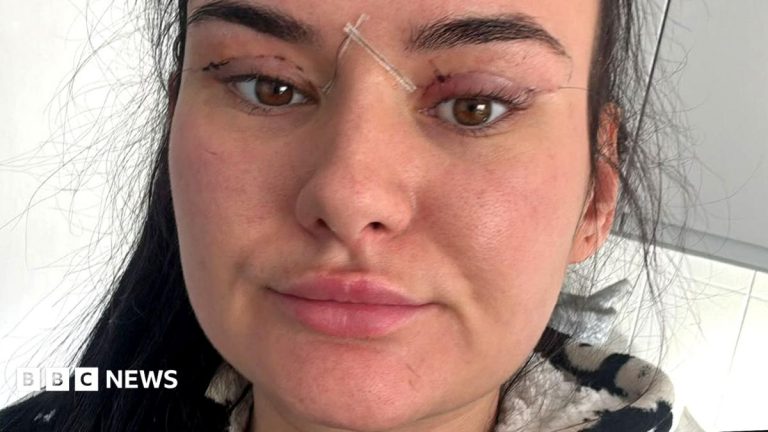 Open wounds and eyes that can’t close – women warn about cheap bleph eyelid surgery