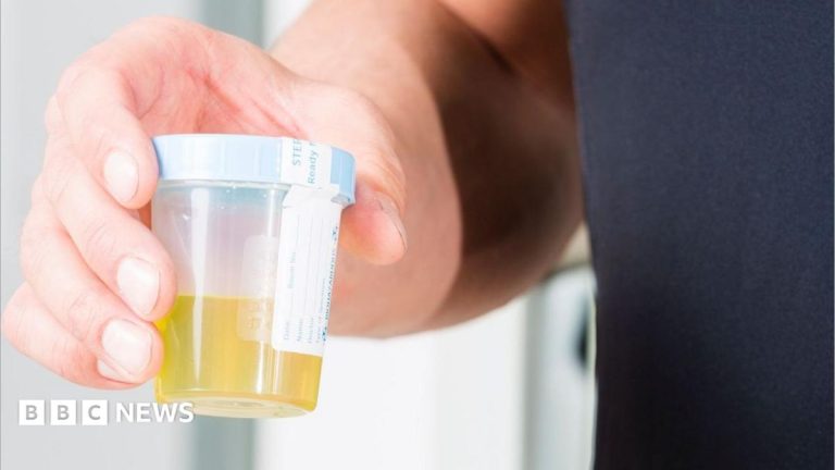 Urine test can spot more than nine in 10 bladder cancers